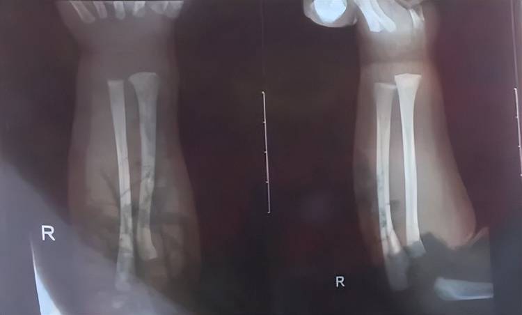 广西一男婴在月子中心被照料20天:身上2处骨折,育婴室监控无法查看