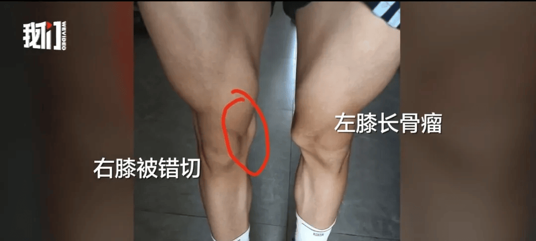 17岁体育生左膝长骨瘤却被错切右膝！母亲：拒绝和解