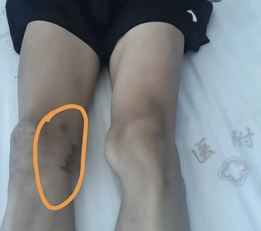 17岁体育生左膝长骨瘤却被错切右膝!母亲:拒绝和解