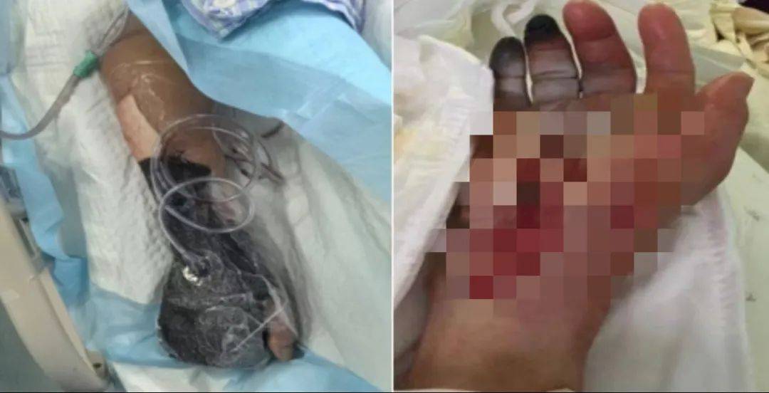 戴手套!戴手套!死亡率近100%,浙江已有人中招