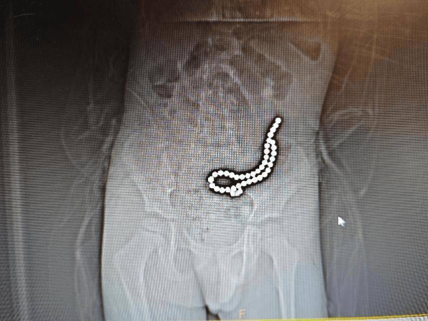 整整37颗!云南4岁孩子身体里取出……医生紧急提醒!