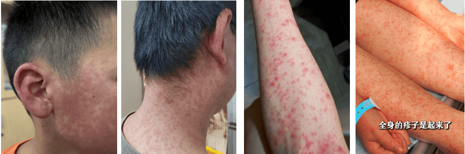 超6000例!仍在新增!或发展成慢性病及有后遗症!上海华山医院:这些驱蚊产品没用!