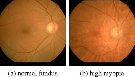 近视超这个度数,眼部疾病风险骤升!