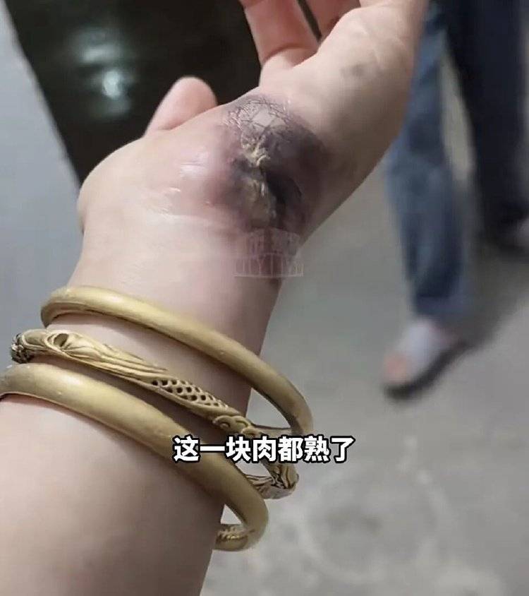 手被烧熟！金手镯被烧熔！女子给电动车充电，不慎碰到充电口受伤